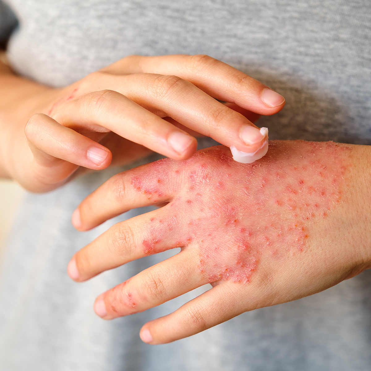 Hand Eczema hand Dermatitis South West Dermatology